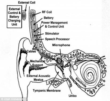 助听器线圈